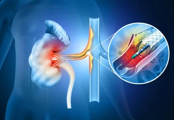 stone & endourology