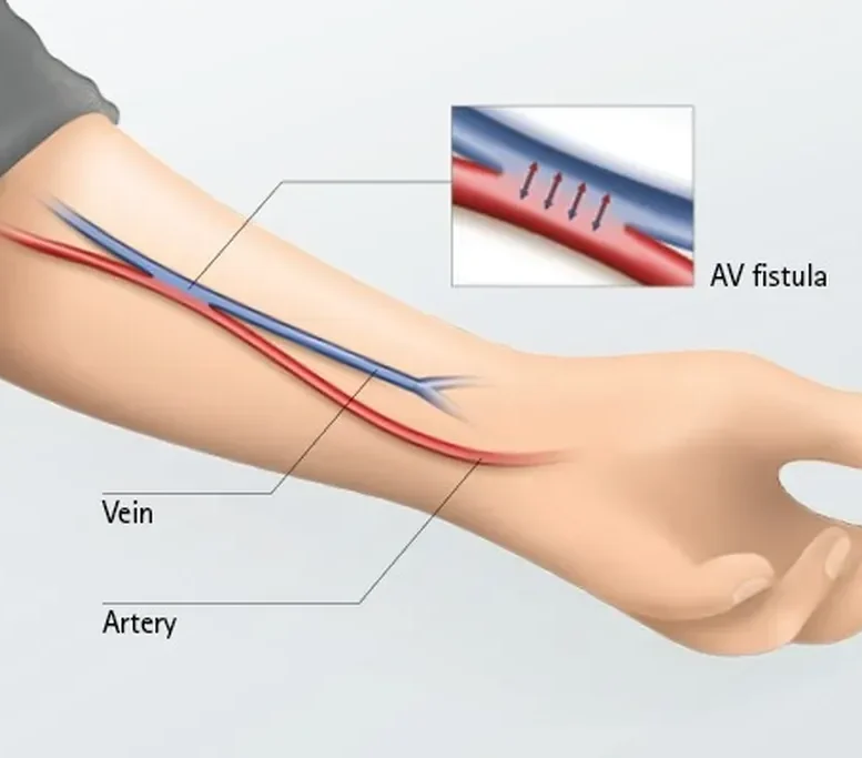 a v fistula reconstruction