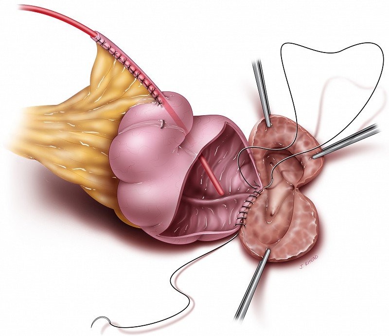 bladder augmentation surgery