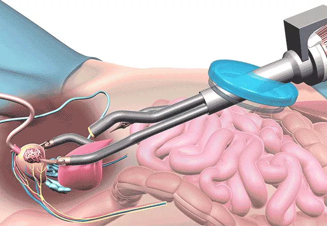 laparoscopic radical prostatectomy