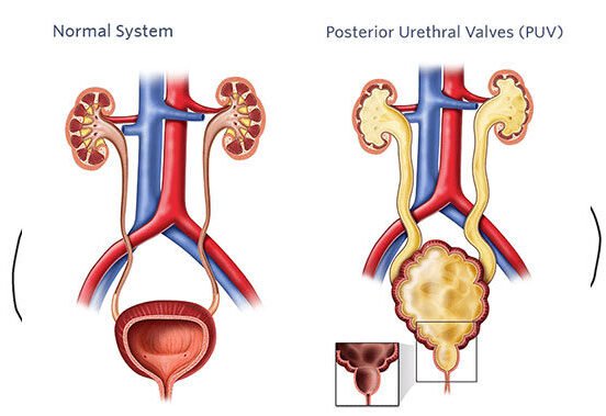 puv fulguration treatment e1781003034434