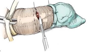 penectomy surgery