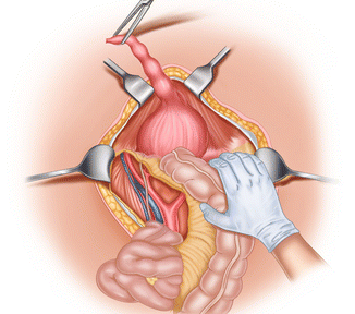 radical cystectomy