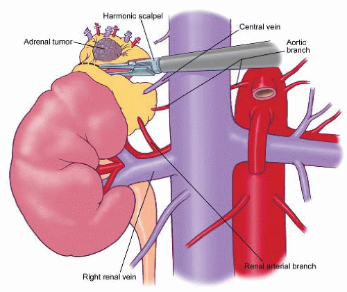 radical laparoscopic adrenalectomy