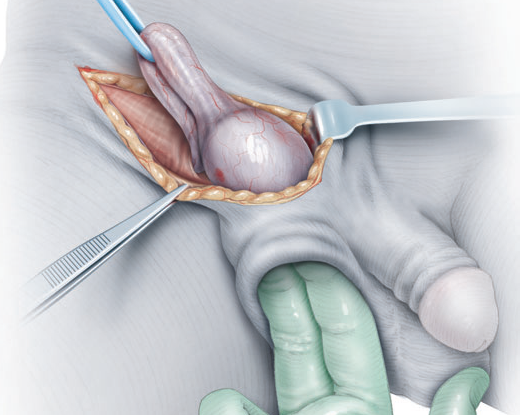 radical orchidectomy