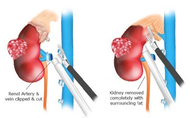 simple laparoscopic nephrectomy