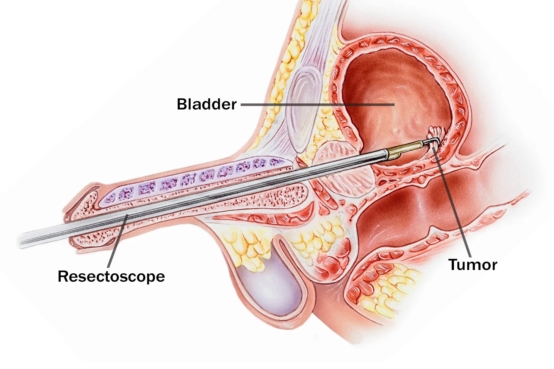 turbt surgery