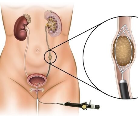 ureteroscopy 1