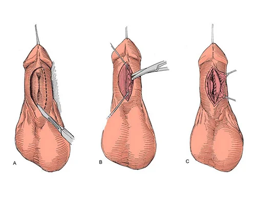 urethroplasty surgery