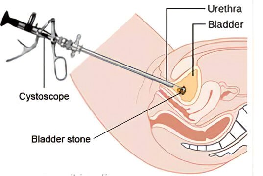 endoscopic surgery for bladder stones