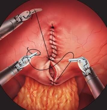 VVF Repair Surgery